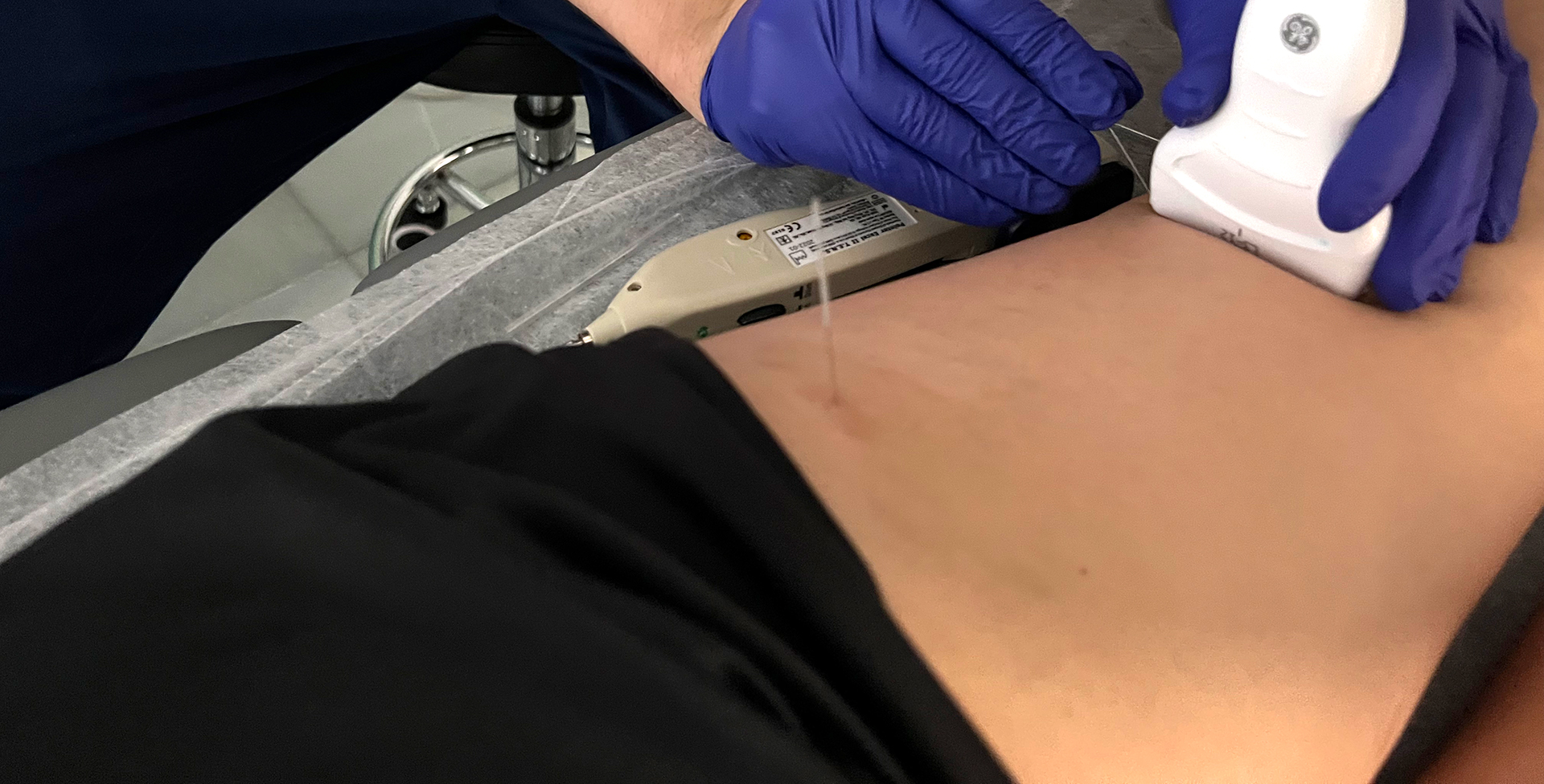 qué es la punción seca qué es la punción seca